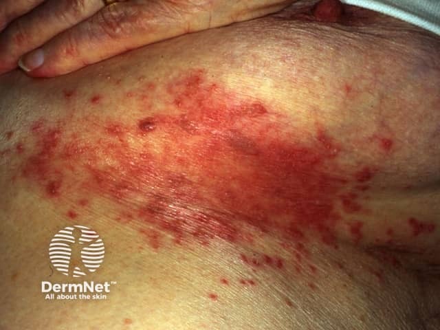 क्यान्डिडियासिस