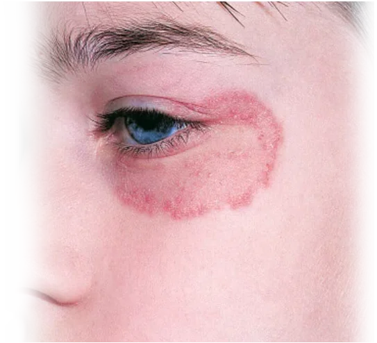 फंगल छाला रोग