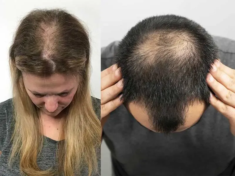 कपाल झर्ने समस्या